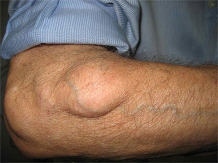 Lipoma Causes, Symptoms, Treatments, and More - WebMD