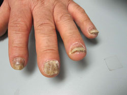 Fungal nail infections, or onychomycosis, are more common on the toenails