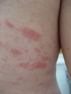 christmas tree rash remedy christmas tree rash remedy