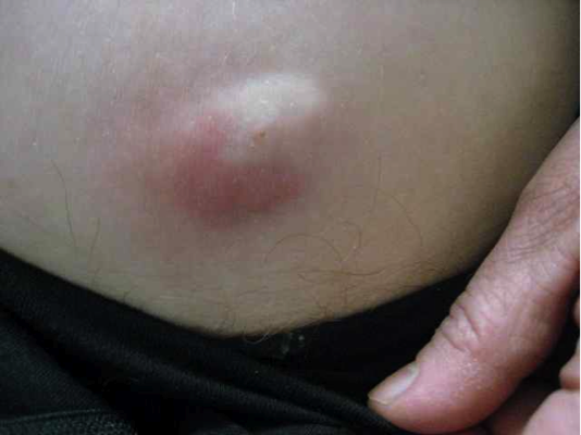 Cysts On Penis Pictures 118